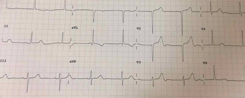 t波改变是指心电图上的向量学改变,这种向量学的改变通常是表示心脏